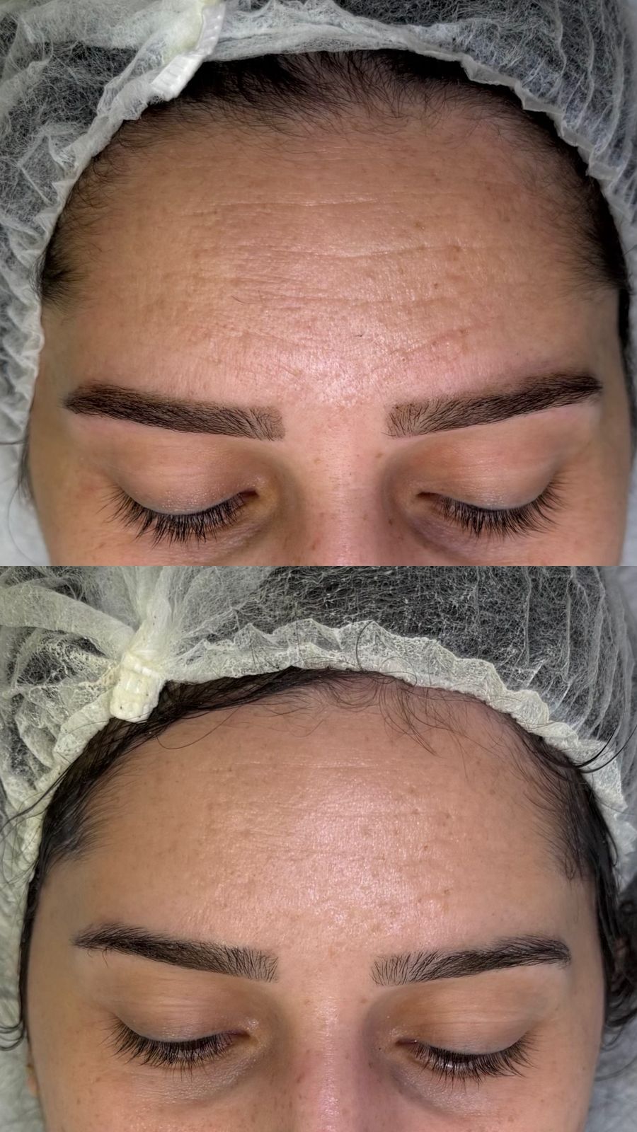 Antes e Depois Limpeza e Peeling
